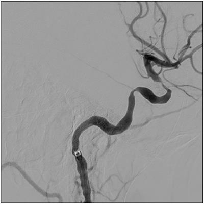 Endovascular Treatment of Intracerebral Giant Cell Arteritis